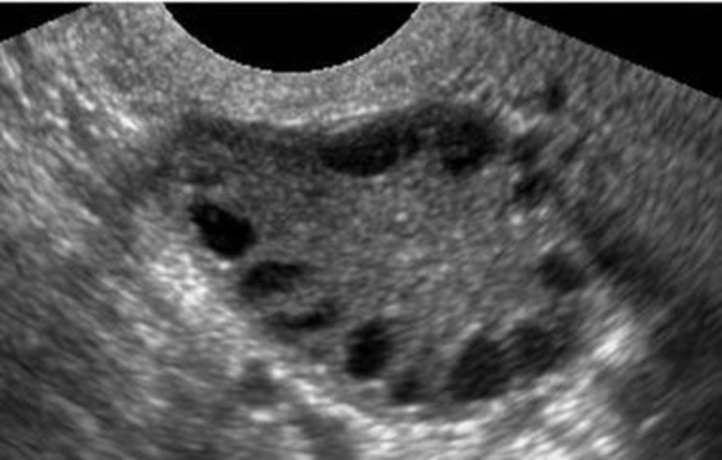 <p>normal ovary with multiple small immature follicles; "string of pearls"</p>