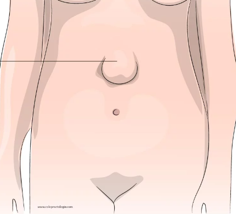 <p>op middellijn boven navel kleine harde massa </p>