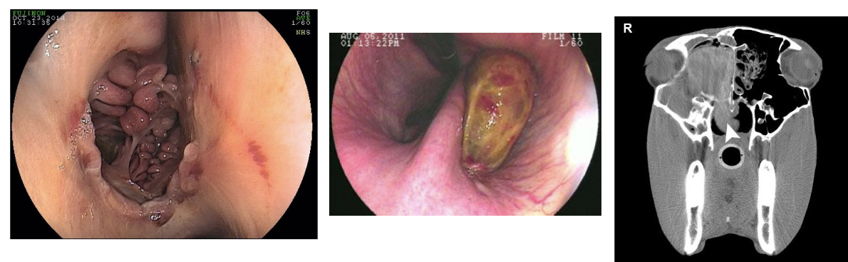 <p>frontal sinus: ethmoid hematoma</p>