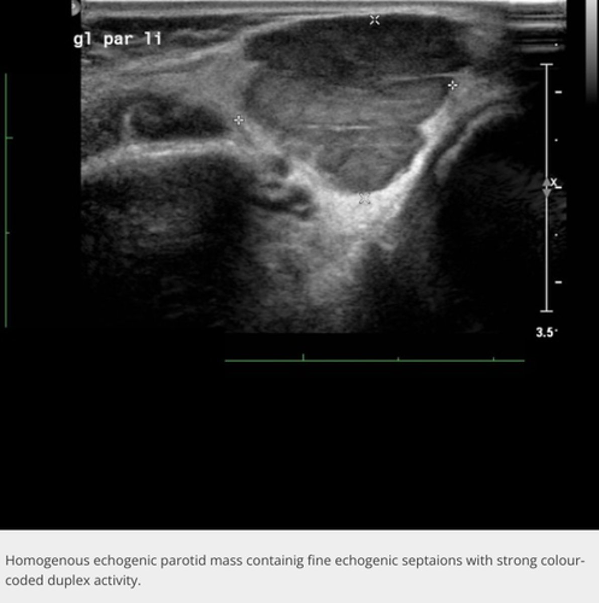 <p>Etiology</p><p>-Most common vascular mass in infants </p><p>-Usually located in the parotid gland (80%)</p><p>Clinical findings</p><p>-Painless</p><p>-Compressible, slow growing mass</p><p>-May have red or blue skin colouring</p><p>Sonographic findings</p><p>-Heterogeneous, hypoechoic enlargement or mass</p><p>-Hypervascular</p><p>-Well circumscribed</p><p>-Usually located in the parotid gland (80%)</p>