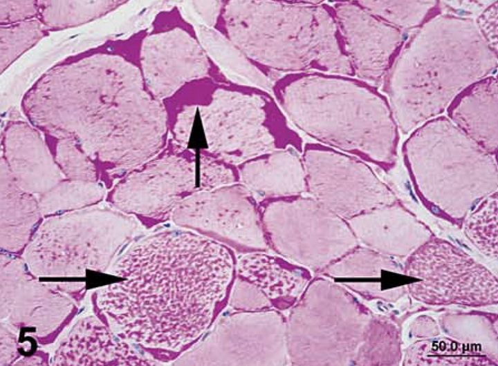 <p><span style="background-color: transparent;">Skeletal muscle biopsy stained with PAS. </span></p><p><span style="background-color: transparent;">What is your diagnosis and why?</span></p>