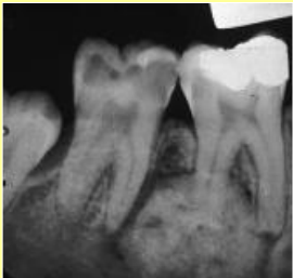 <p>radiolucent rim is contiguous w PDL and PDL is NOT in tact at involved portion of the root, effacement of root </p>
