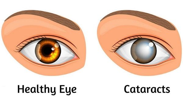 <p>cloudiness of the lens and can be treated through surgery</p>