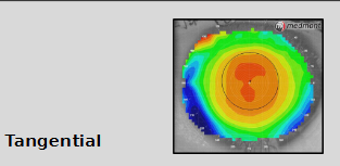 <ul><li><p>Measures curvature at a point on cornea in meridional direction relative to the other points on a particular ring </p></li><li><p>Does not assume: </p><ul><li><p>eye is spherical</p></li><li><p>refracted rays converge to central point on visual axis: each data point is in relation to surrounding data points </p></li><li><p>where the centre of radius might be  </p></li></ul></li></ul><ul><li><p>Simply look at a certain part of the cornea + measure the radius of that point under 90◦ (as a tangent)of which the centre of radius could be anywhere</p></li></ul><p></p>