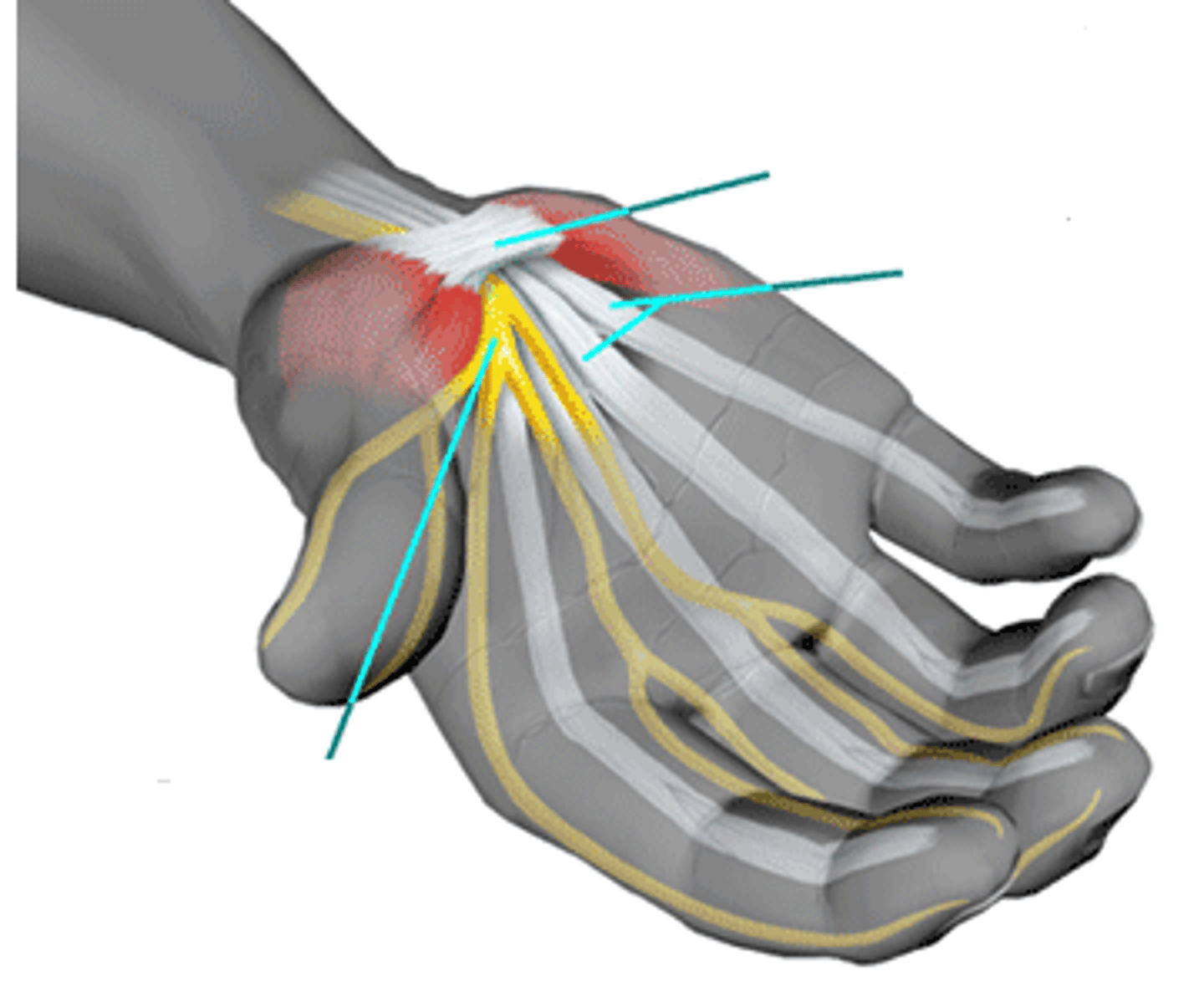 <p>compression of median nerve</p><p>common in pregnancy, diabetes, RA</p><p>burning, tingling, pins and needles and numbness at night</p><p>positive tinels sign / phalens</p>