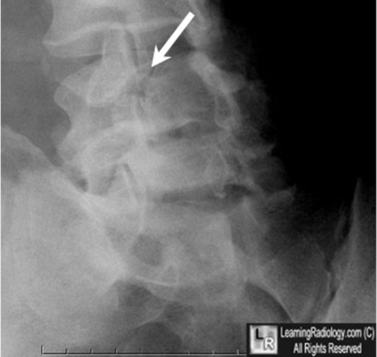 <p>A break in the _____ occurs as a stress fracture in adolescence, usually in very active children that do sports with repetitive hyperextension (gymnasts, wrestlers, football players, etc.)</p>