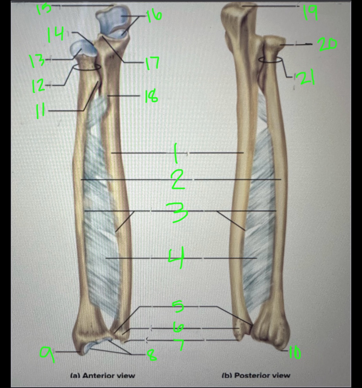 <p>radial notch of ulna</p>