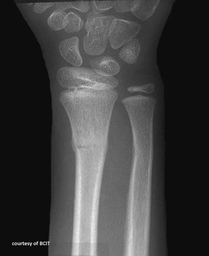 <p>Why are torus or buckle fractures more common in children?</p>