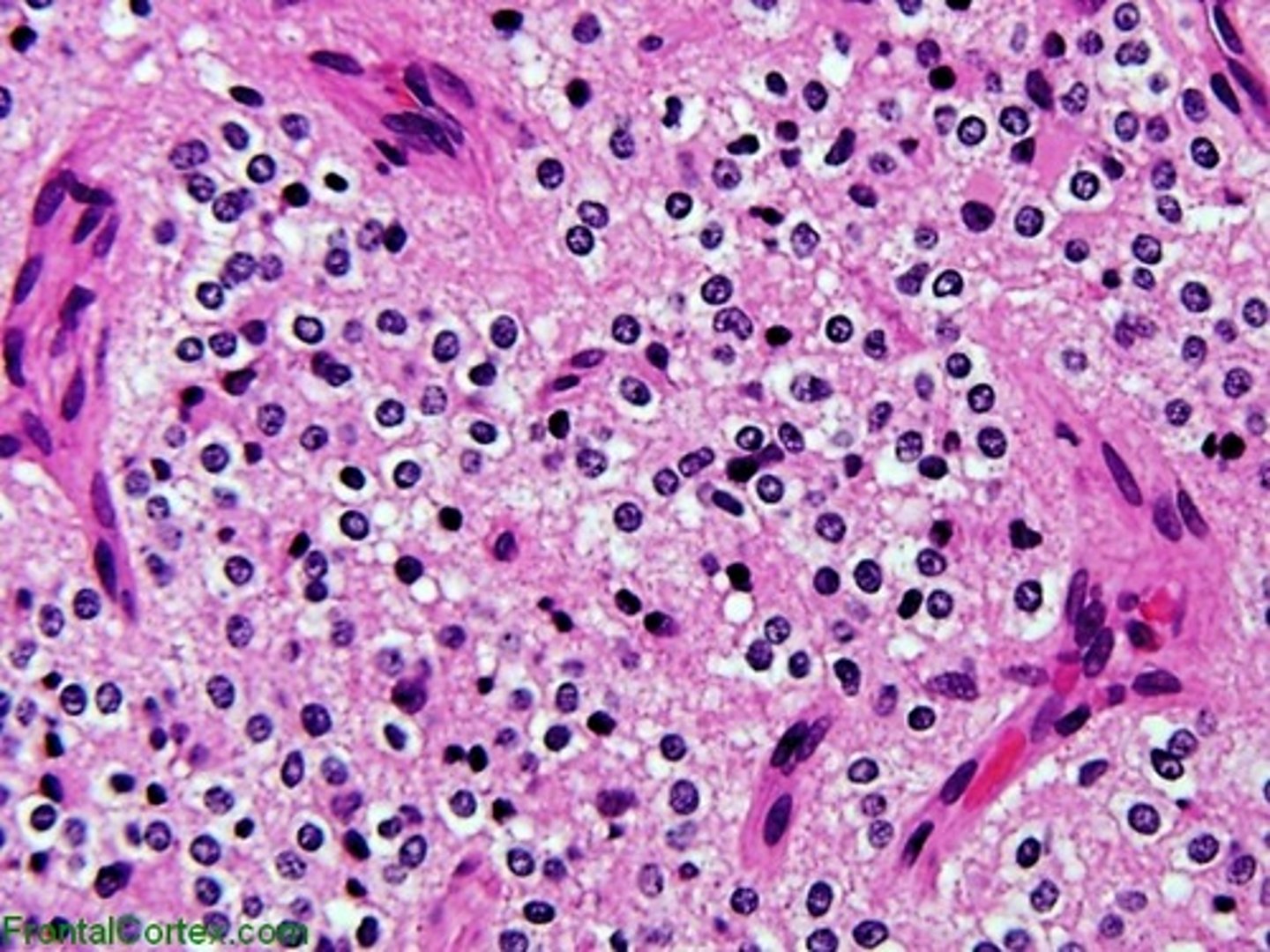 <p>Malignant tumor of oligodendrocytes</p>