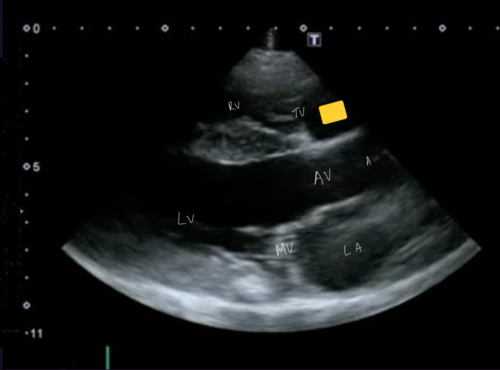 <p>Right parasternal 5 chamber view</p>