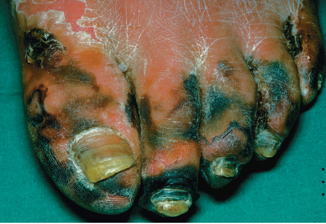 <p><span><span>Agent: </span><em><span>Clostridium perfringens</span></em><span> (anaerobic)</span></span></p><p><span><span>Symptoms: </span></span><span style="background-color: transparent;"><span>Intense pain at site of infection; </span><strong><span>blackening of infected muscle and skin</span></strong><span>; production of bubbles of hydrogen and CO2</span></span></p><p><span style="background-color: transparent;"><span>– May break out with a frothy brownish liquid</span></span></p><p><span style="background-color: transparent;"><span>– necrosis( tissue death) </span></span></p><p>Transmitted through contact with broken skin</p><p><strong>Diabetics are susceptible </strong></p>