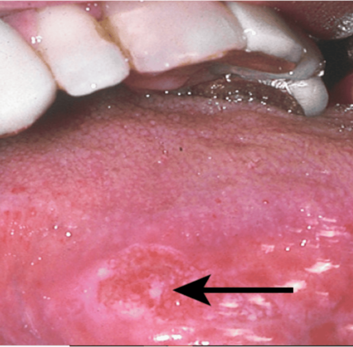 <p>Oral cancer recommendations?</p>
