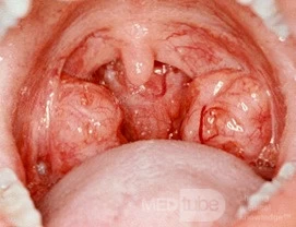 <p>common in children</p><p>may protrude as far as to midline</p>