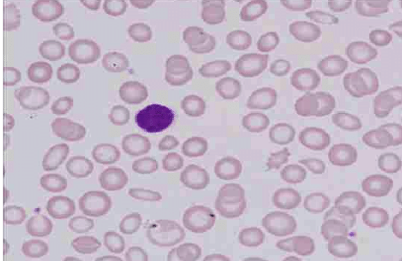 <p>what disease/condition is associated with marked anisocytosis/poikilocytosis, microcytosis, and hypochromia?</p>