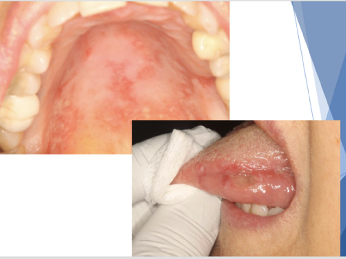 <p>Patient presents with these oral lesions but reports no other symptoms. Patient also has some hyperpigmented lesions on skin. What is the most likely differential?</p>