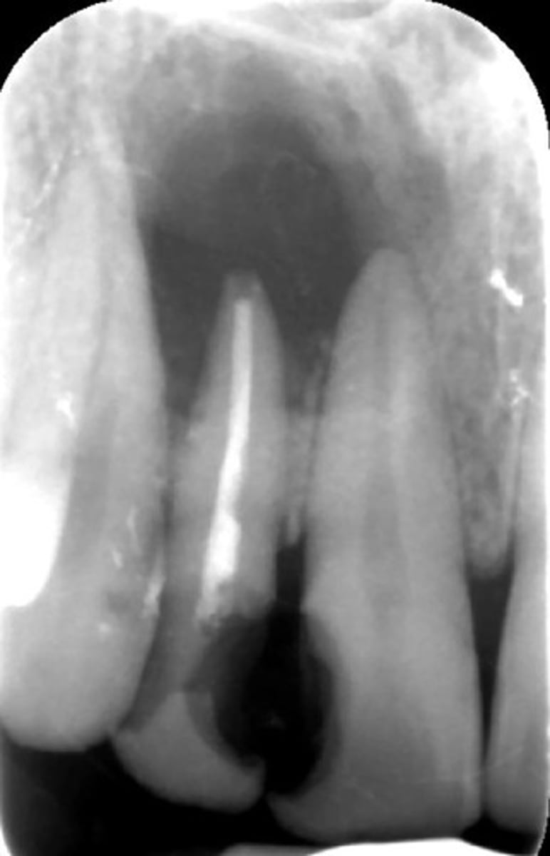 <p>all of the following could be a differential diagnosis for the following lesion EXCEPT?</p><p>A. radicular cyst</p><p>B. Periapical granuloma</p><p>C. apical rarefying osteitis</p><p>D. renal osteodystrophy</p>