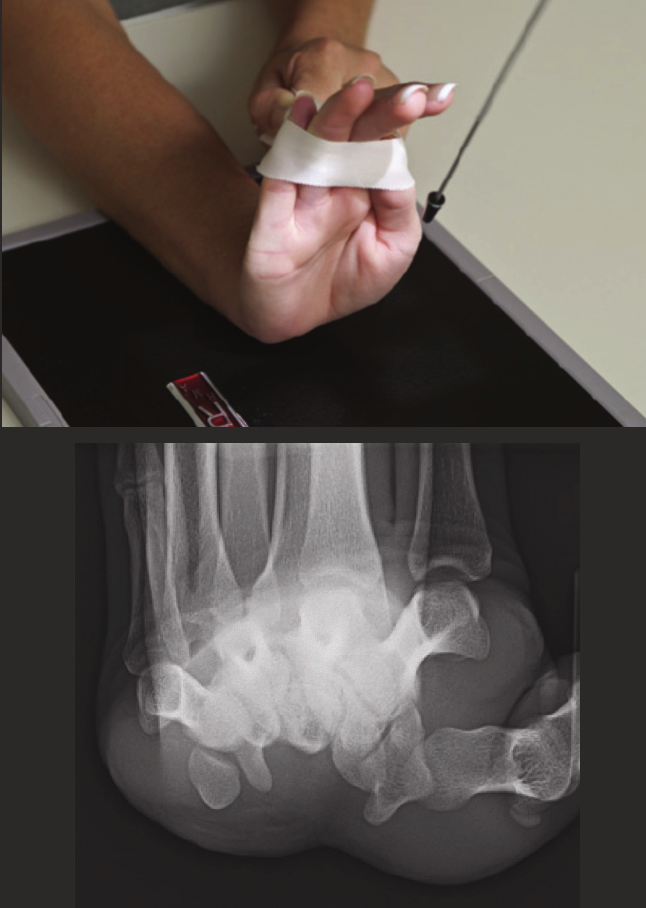 <ul><li><p>CR 25-30 degrees to long axis of hand.</p></li><li><p>Centre to middle of palm.</p></li></ul><p></p>
