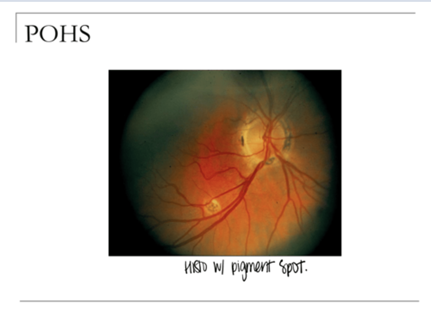 <p>Presumed Ocular Histoplasmosis Syndrome (POHS) (Pic)</p>