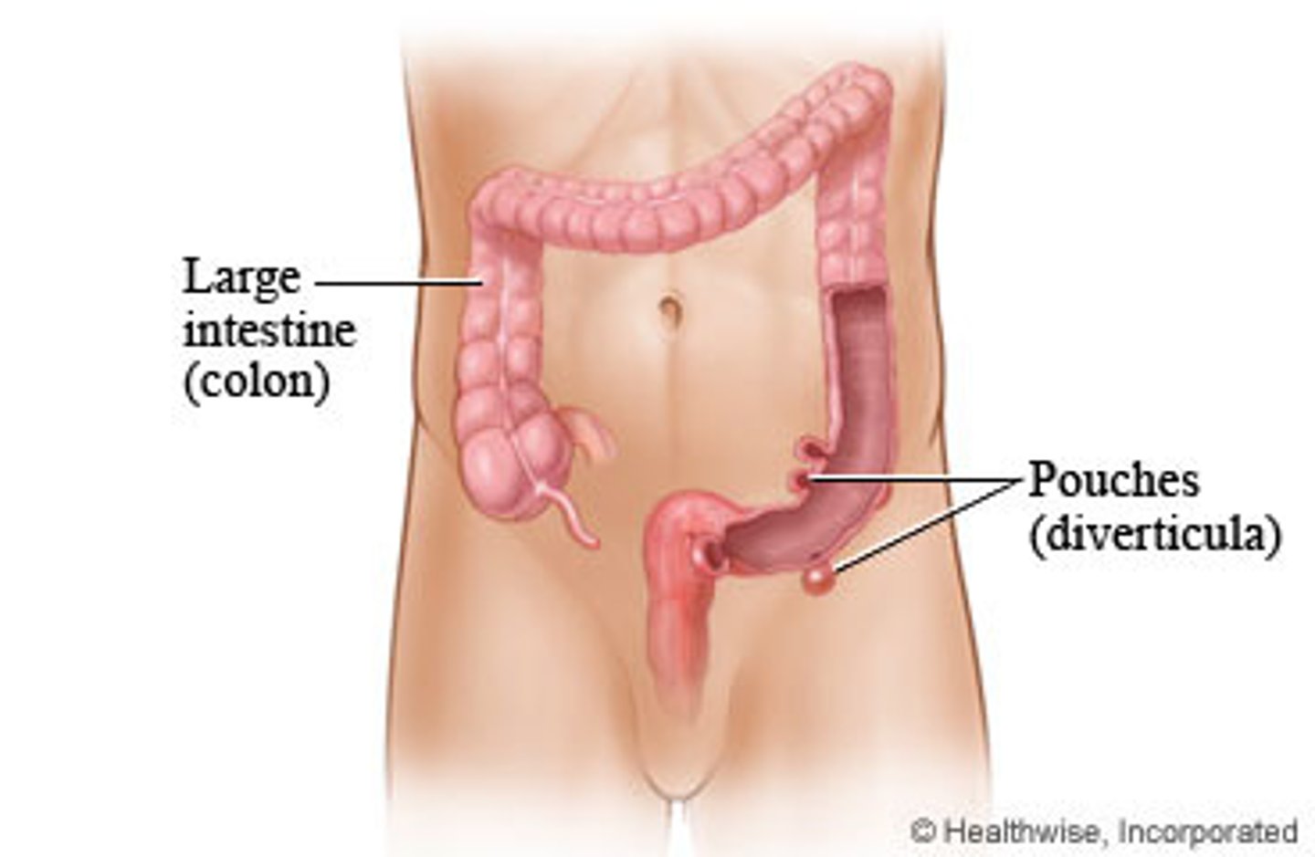 <p>Inflamed/infected diverticuli</p><p>Pain and cramping in lower left quadrant (primary symptom), Nausea, Vomiting, Slight fever, Elevated WBC, constipation, chills, vomiting</p><p>Complications: Bleeding, infections, intestinal blockage, abscess, perforation, tears in colon, fistulas, peritonitis</p>