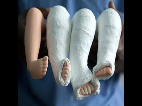 <ul><li><p>50% bilateral </p></li><li><p>always ortho &amp; PT </p></li><li><p>non-op: Ponseti technique </p></li><li><p>operative: percutaneous transverse Achilles lengthening ± corrective osteotomy </p></li></ul>