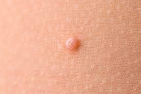 <p><span>A raised solid lesion greater than 0.5cm in diameter. This can be superficial or deep in the skin.</span></p>
