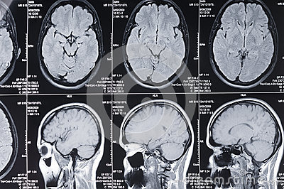 computer enhanced x-ray of brain structure