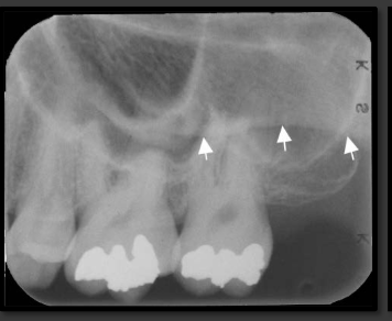 <p>It is a radio opacity that extends off of the U shaped structure of the zygomatic process of the maxilla.</p>