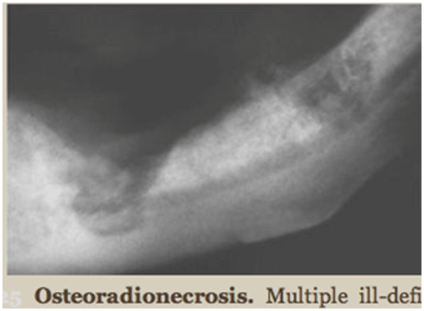 <p>similar to chronic osteomyelitis</p><p>more widespread</p>
