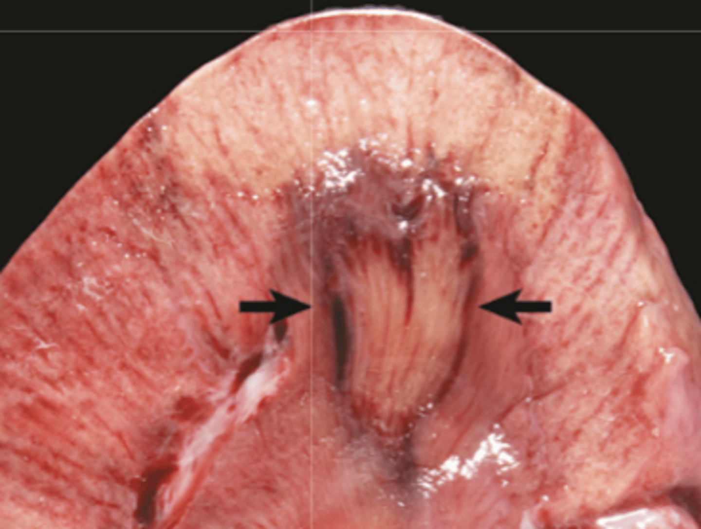 <p>What type of necrosis is being shown in this photo?</p>