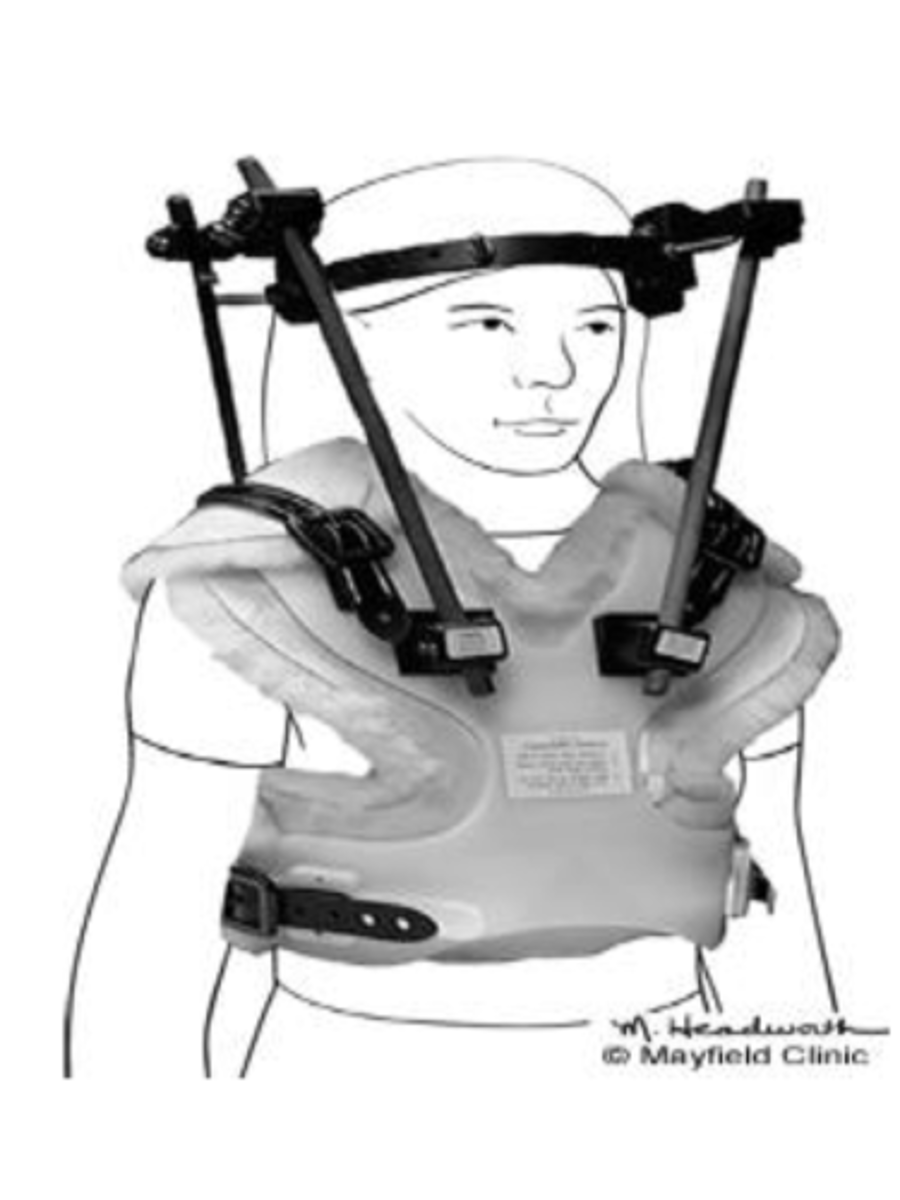 <p>immobilization cervical - halo:</p><p>- for cervical ___</p><p>- halo ring with 4 steel screws attached to outer skull</p><p>- body jacket with 4 vertical posts</p><p>- contraindicated with severe ___ involvement</p><p>- most ___</p>