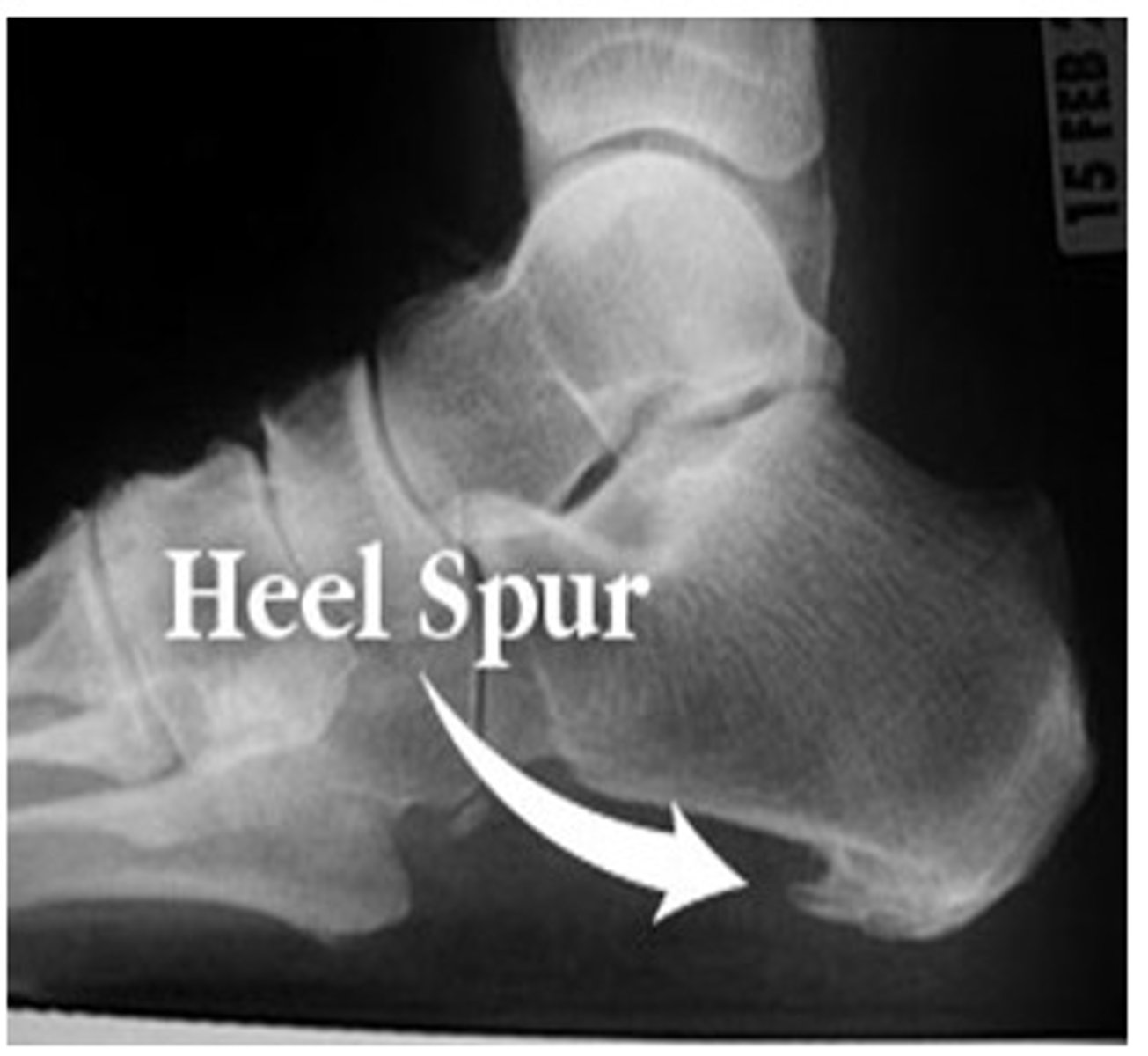 <p>heel spur</p>