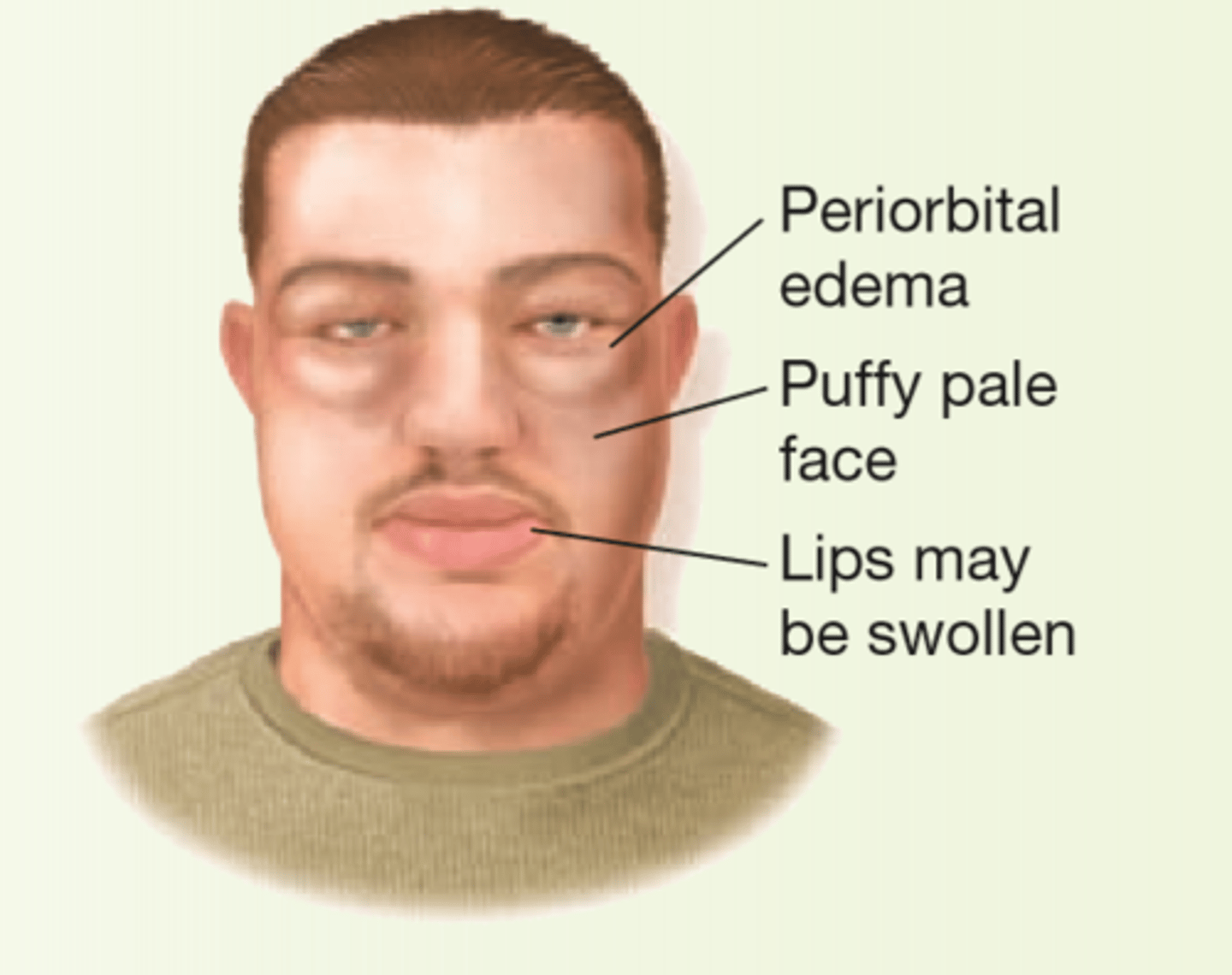 <p>group of clinical signs and symptoms caused by excessive protein loss in urine</p><p>- periorbital edema</p><p>- puffy pale face</p><p>- lips was swell</p>