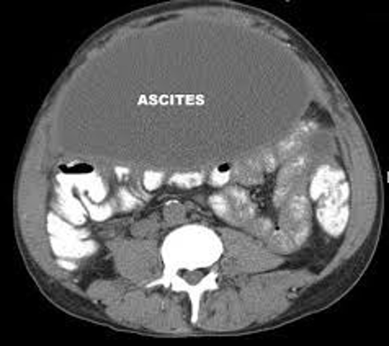 <p>The accumulation of fluid in the abdominal cavity.</p>