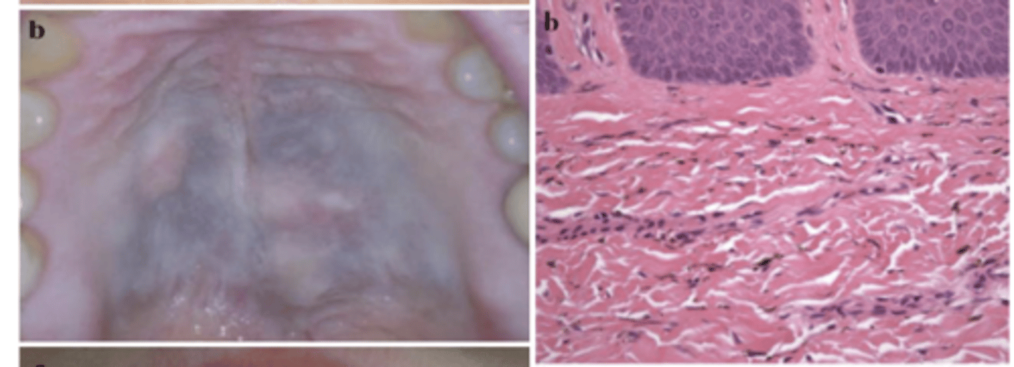<p>What type of pigmented lesion?</p>