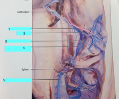 <p>pancreaticomesenteric artery</p>