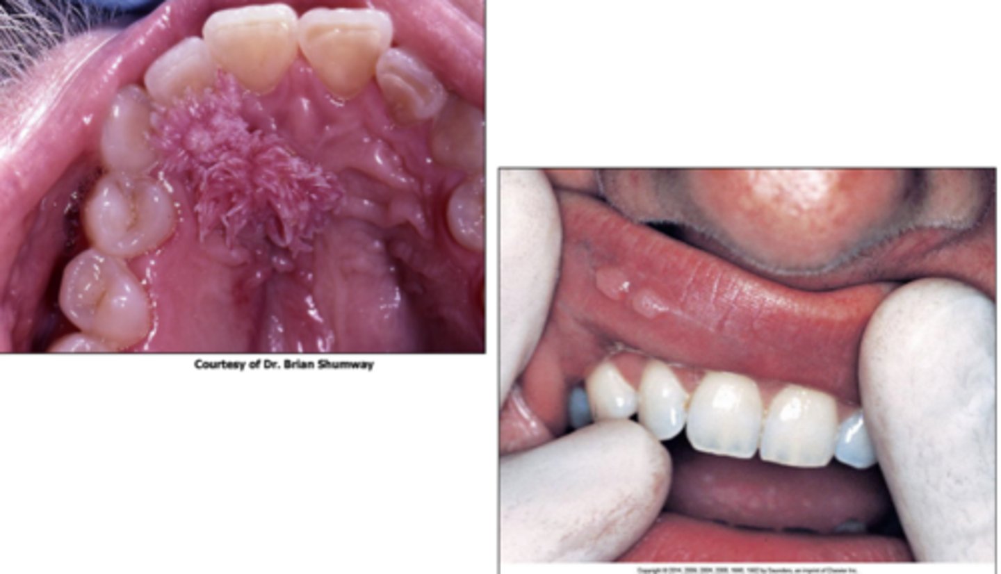 <p>exophytic</p><p>- clinically: multiple lesions / proliferation &amp; recurrence</p><p>In HIV negative patients, it usually occurs as a single lesion and does recur</p>