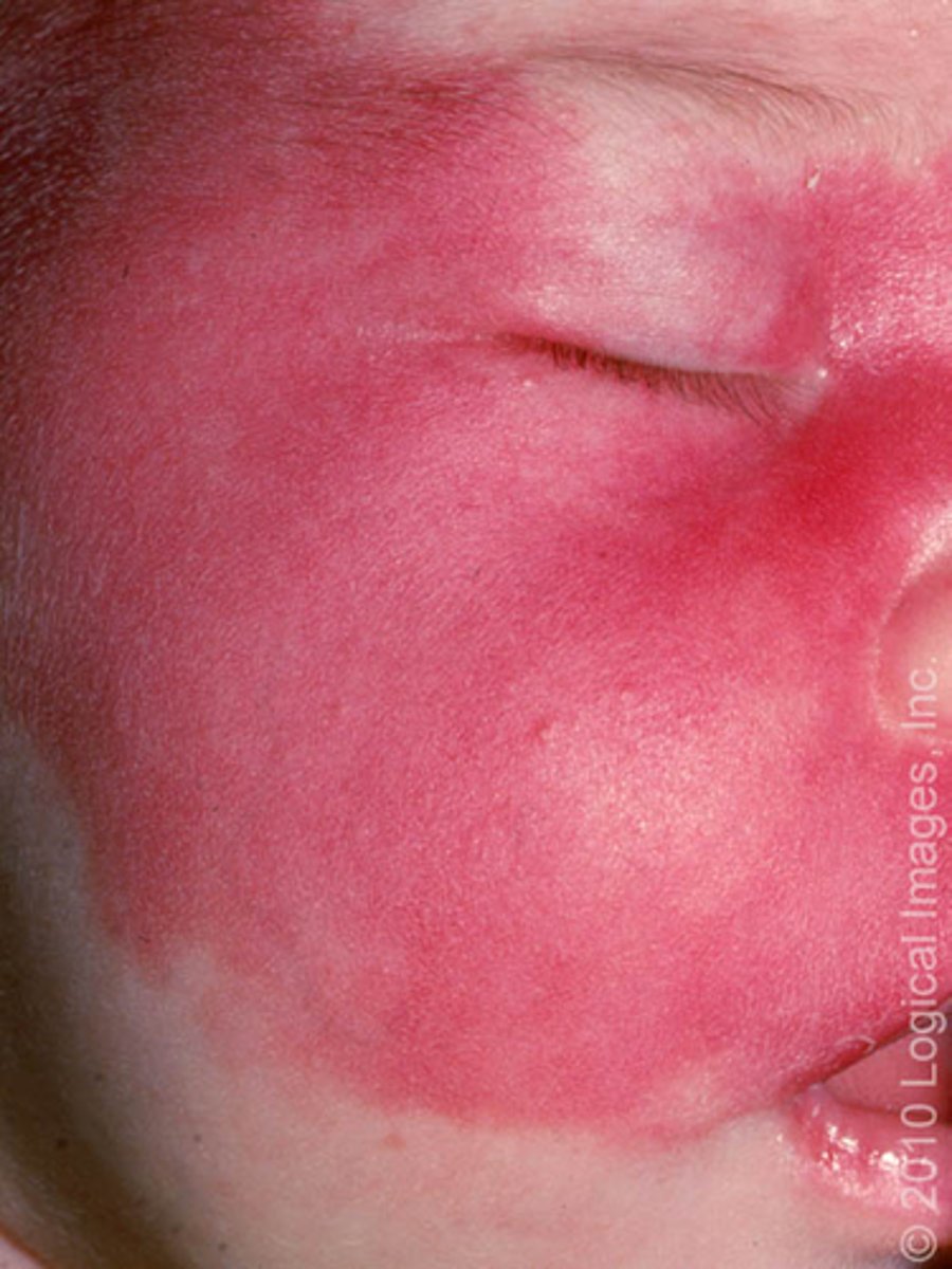 <p>Nevus flammeus, or port wine birthmark, is a low-flow capillary malformation that can occur anywhere on the body (picture 5). It may or may not be a benign finding in the newborn.</p>