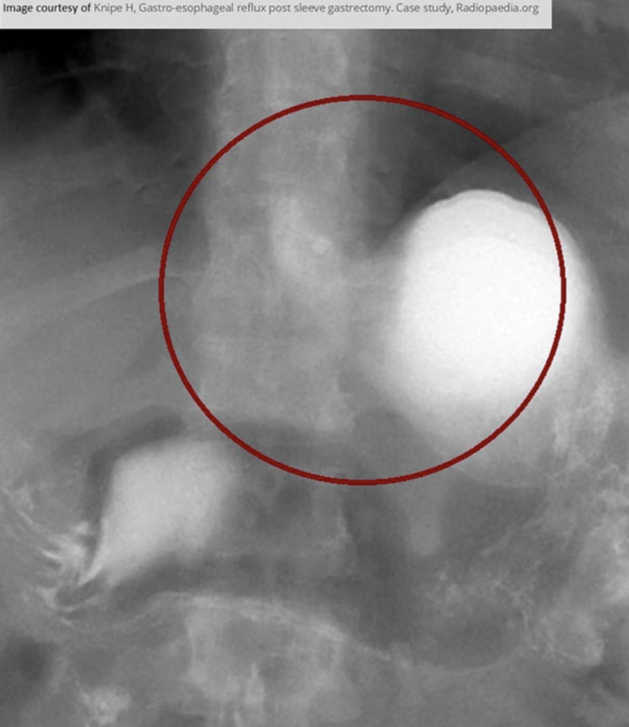 <p>for GERD </p><ul><li><p>included in a UGI to assess reflux</p></li><li><p>pt drinks barium and is placed LPO and drinks water during fluoro </p></li><li><p>the rad looks at the cardiac sphincter to see if the barium refluxes while drinking water </p></li></ul><p></p>