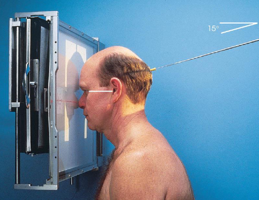 <ul><li><p>patient position:</p><ul><li><p>seated upright or prone</p></li><li><p>MSP centered to midline</p></li><li><p>forehead and nose resting on Bucky</p></li></ul></li><li><p>part position:</p><ul><li><p>MSP and OML perpendicular to IR</p></li></ul></li><li><p>respiration suspended</p></li><li><p>CR:</p><ul><li><p>PA: perpendicular to IR, exiting nasion</p></li><li><p>PA axial: 15 degrees caudad, exiting nasion</p></li></ul></li><li><p>collimation:</p><ul><li><p>1 inch beyond skin line of the skull<br></p></li></ul></li></ul><p></p>