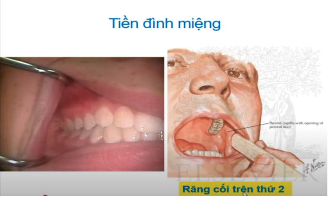 <p>Khi ngậm miệng, tiền đình miệng thông với ổ miệng chính qua vị trí nào ? </p><p>Vị trí lỗ đổ của tuyến nước bọt mang tai ? </p><p>Dấu koplic, bệnh sởi có liên quan đến phần nào của ổ miệng ? </p>