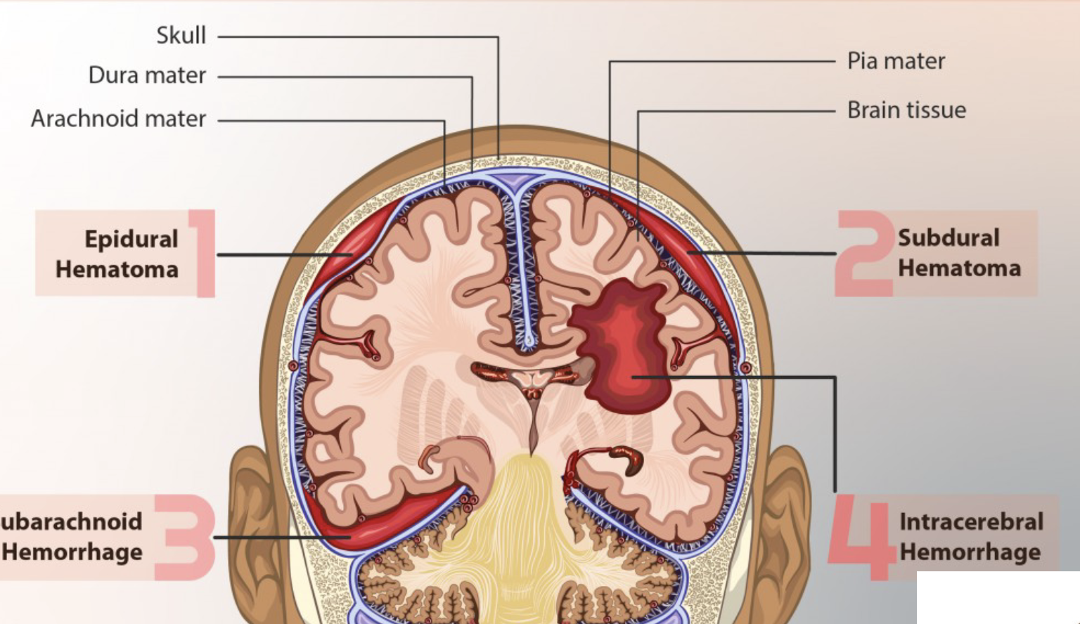 <p>A <strong><span style="color: purple">subdural hematoma</span></strong> is bleeding between the _____ _____ and _____ _____ covering the brain is caused by tearing of _____.</p>