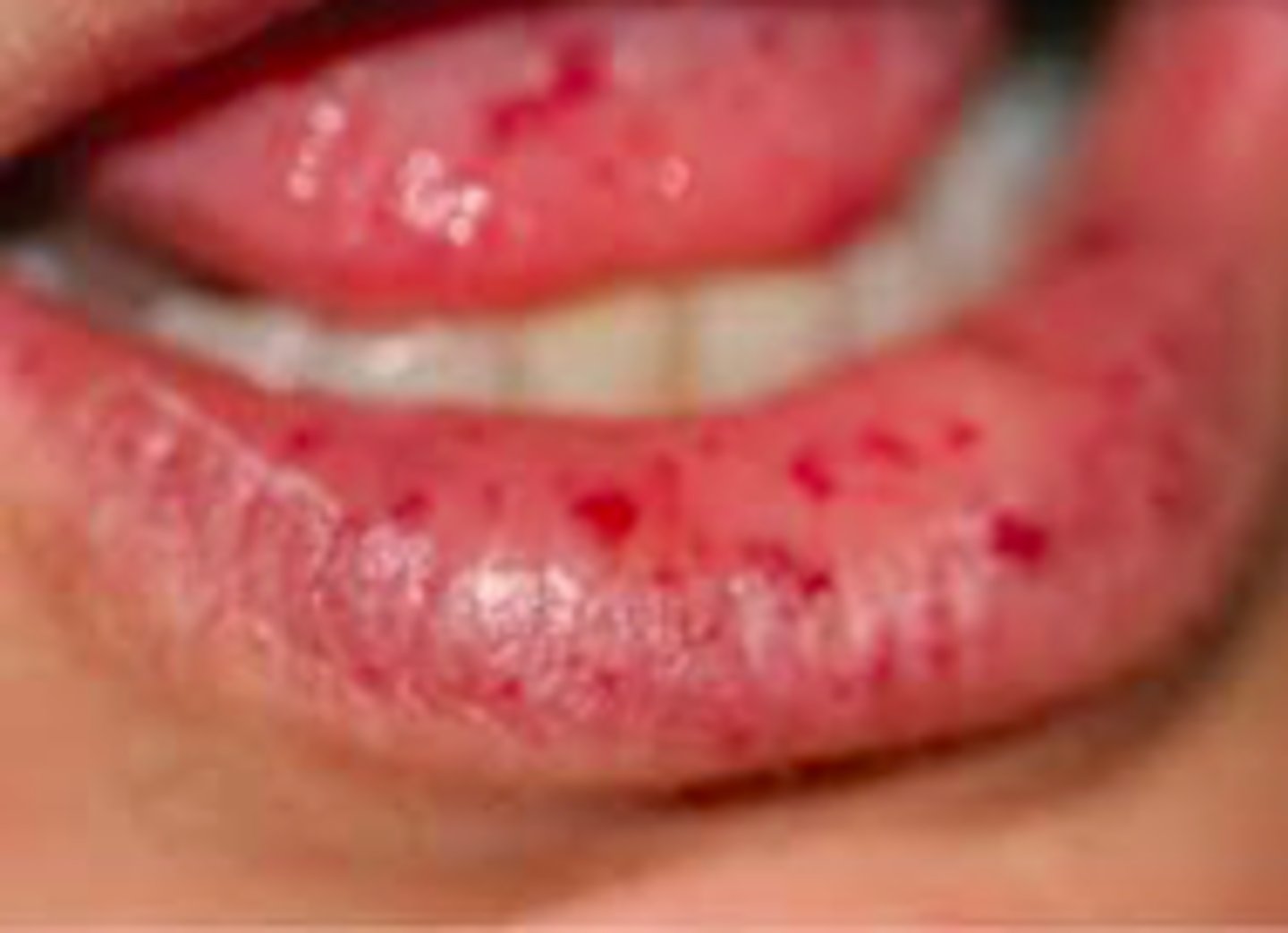 <p>What has the following characteristics?</p><p>- Presentation: Vascular malformations of skin and internal organs (GI tract, lungs, brain)</p><p>- Autosomal dominant</p><p>- Presents in 2nd or 3rd decade</p><p>- Small, dilated blood vessel near surface of skin/mucous membranes. Common on lips, tongue, face, chest, fingers, GI tract</p><p>- Arteriovenous shunts/malformations (AVMs)</p>