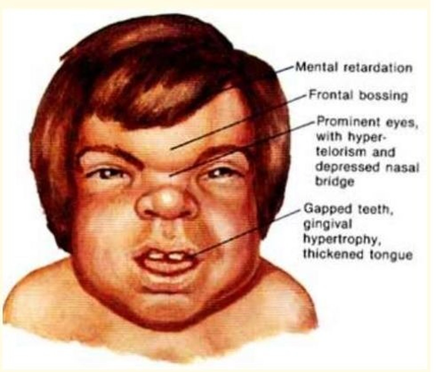 <p>• Lysosomal storage disorder (LSD)</p><p>• Accumulation of dermatan sulphate in lysosomes</p><p>• Mental retardation, frontal bossing, prominent eyes, hyper-telorism, depressed nasal bridge, gapped teeth, gingival hypertrophy, thickened tongue</p>