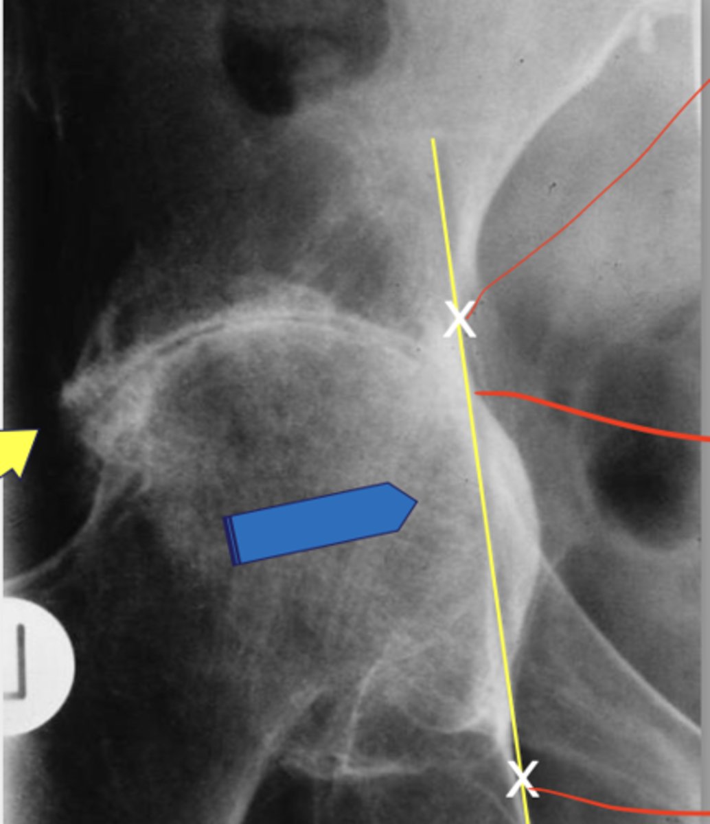 <p>-Rheumatoid arthritis</p><p>-Align most lateral aspect of greater sciatic notch with obturator foramen</p><p>-Draw line done</p><p>-If femoral had crosses the line, it is positive</p>