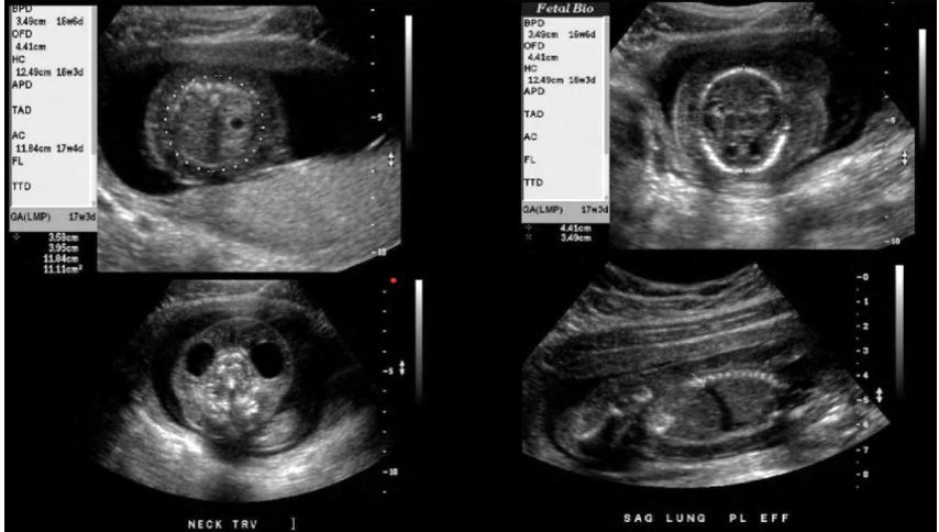 <p>which are signs of fetal hydrops</p><p>a) pleural effusion + macrocystic lungs</p><p>b) scalp edema + ascites </p><p>c) theca lutein cyst + anasarca</p><p>d) skin edema + facial clefting</p>