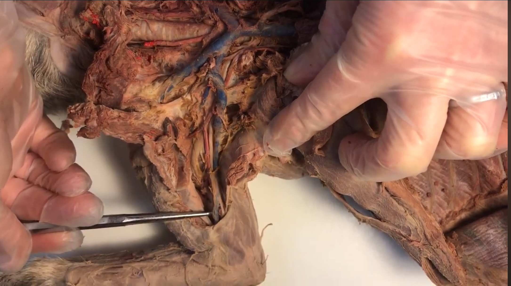 <p>What vein is this</p>