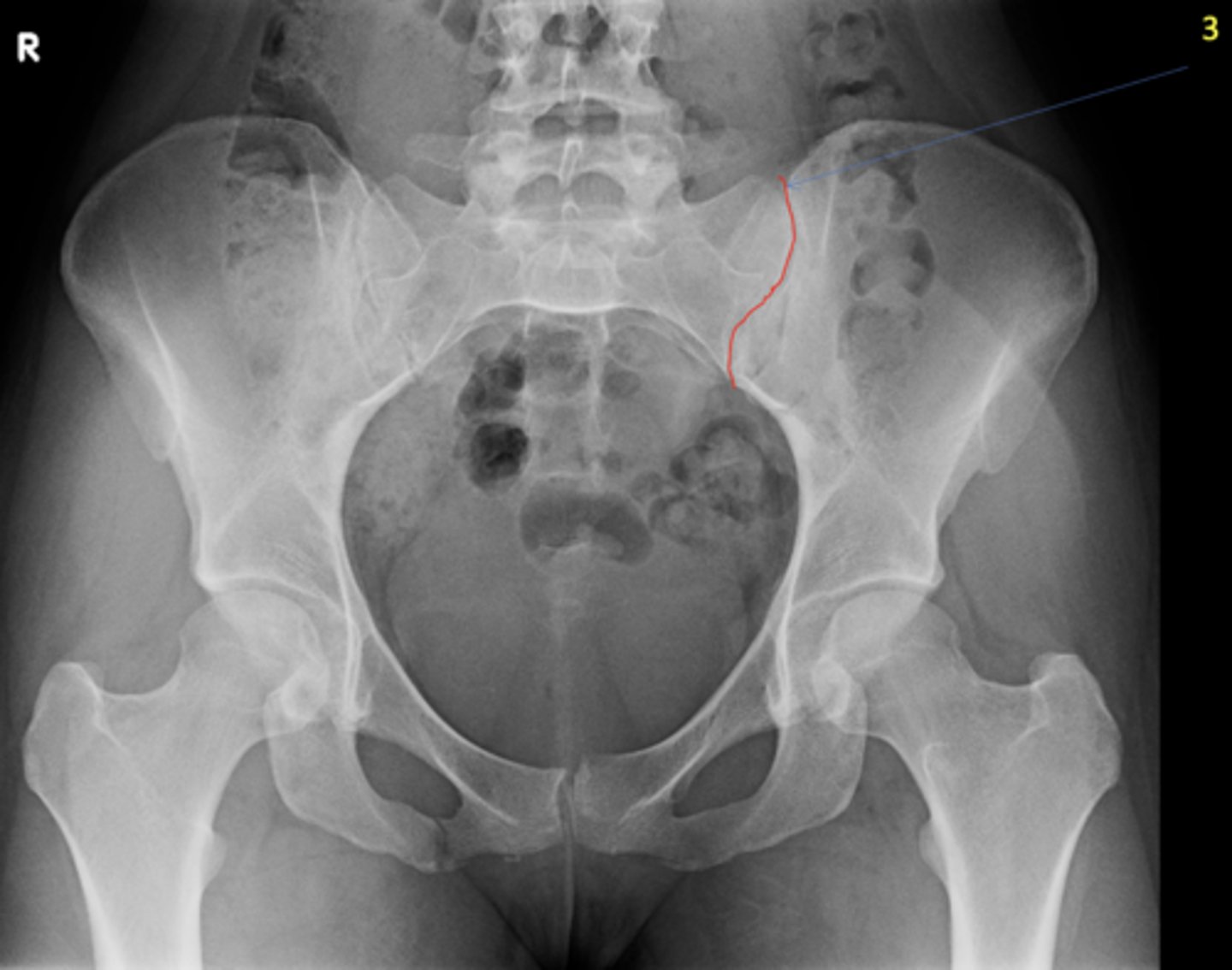 <p>ID 3 (joint)</p>