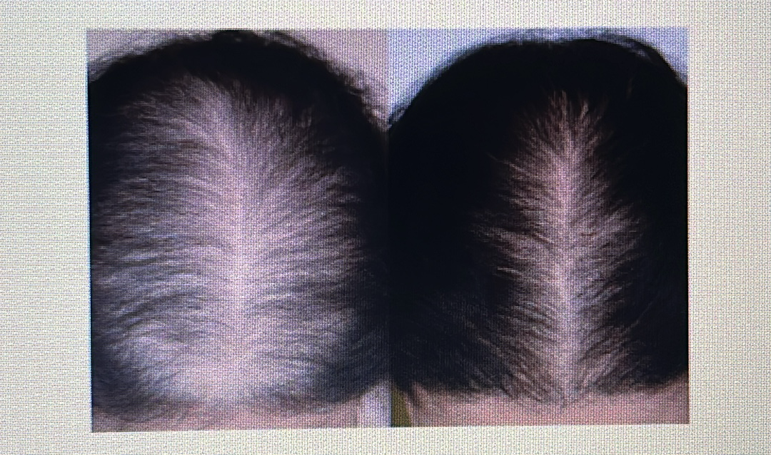 <p>HAIR DISORDER</p><p><span style="font-family: Calibri, sans-serif"><strong>Androgenic alopecia</strong>: Baldness in both genders/sexes that’s based on genetics.</span></p>