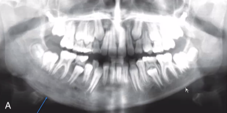 <p>reactive process in which new bone is deposited within periosteum for bone expansion</p><ul><li><p>consider osteomyelitis, osteosarcoma (cancer), langerhans cell histiocytosis (cancer)</p></li></ul><p></p>