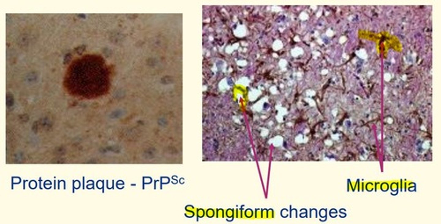 <p>- Spongiform changes</p><p>- Microglia </p>